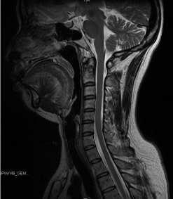A Very Rare Case of Fibrous Dysplasia Located in Odontoid Process