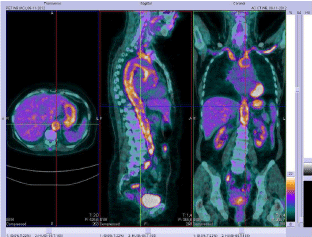 Large Vessel Vasculitis - Evaluation with 18F-FDG PET-CT